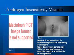 Diese seite wurde zuletzt am 3. Androgen Insensitivity Syndrome Ais Alice Mann Maureen Obrien
