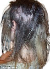 From Blinding Headaches To Bleeding Scalps And Permanent Baldness The Hidden Dangers Of Hair Extensions Revealed Hair Extension Clips Real Hair Extensions Hair Extensions