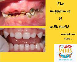 Importance Of Milk Teeth Is It Important To Treat Cavitated Milk Teeth Pediatric Dental Dental Dental Clinic