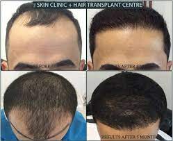 Fue Hairtransplant Surgery Results Just After 5 Months Post Surgery Fue Hair Transplant In Liverpool U Hair Care Volume Hair Care Regimen Blonde Hair Care