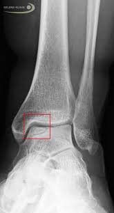Nih annual progress reports received on/after october 1, 2014 must include a section to describe how individual. Osteochondrosis Dissecans Od Im Sprunggelenk Gelenk Klinik De