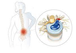 Check spelling or type a new query. Hernia De Disc Cauze Simptome Tratament Si Preventie Kinetic Ro