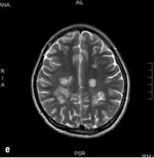 Check spelling or type a new query. Http Revecuatneurol Com Wp Content Uploads 2018 03 Desmielinizacion Del Sistema Nervioso Pdf
