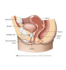 A muscle that surrounds an opening in the body and can tighten to close it: Artificial Urinary Sphincter Implantation In Women Patient Information