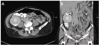 Image result for CT Intravenous Contrast