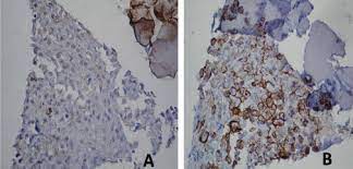 Patients with unresectable malignant pleural mesothelioma. Combined Serum And Immunohistochemical Differentiation Between Reactive And Malignant Mesothelial Proliferations Sciencedirect