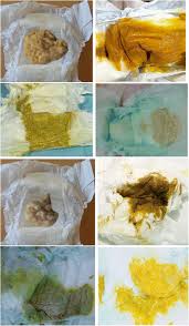 Image result for acholic stools human