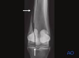 Image result for Lateral Condyle Fracture