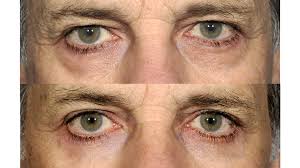 Under eye puffiness is also known by eye bags, or dark under eyes. Eye Bag Surgery Procedure Alternatives Cost Recovery And More