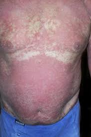 Find 25 synonyms for psoriases and other similar words that you can use instead based on 2 separate contexts from our thesaurus. Image Erythroderme Psoriasis Msd Manual Ausgabe Fur Patienten