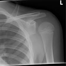 Lightbulb Sign Shoulder Dislocation Shoulder Dislocation Radiology Dislocation