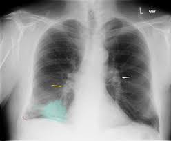 Image result for lung cancer xray