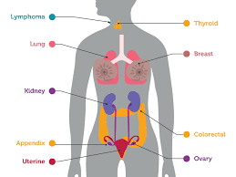 What you think you know about lung cancer is a drop in the bucket compared with the uncertainty you may face once you, or someone near to you, has been diagnosed with the disease. Study Examines Whether Blood Test Can Identify Early Cancers National Cancer Institute