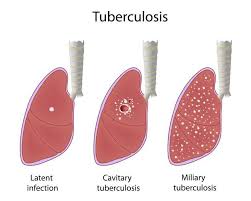 Tuberculosis (tb) is a potentially serious infectious disease that mainly affects the lungs. The True Burden Of Tuberculosis