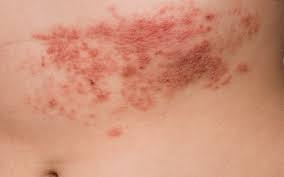 Image result for shingles in children