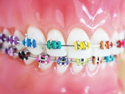 The braces are fine, the main disc and bulb holders are pretty light and bend easily. How To Select The Right Braces Colors Orthodontic Arts