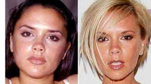 Bichectomia $2999 pesos‼️ ¿cachetes, cara redonda? Bichectomia La Tendencia En Cirugia Estetica Que Adelgaza La Cara Y Resalta Los Pomulos Y Es Irreversible