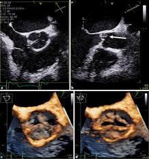 Current trends in diagnosis and treatment. Echokardiographische Notfalldiagnostik Springerlink