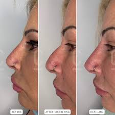Lip Filler Dissolving Process For Migration (In Real Time) - Youtube