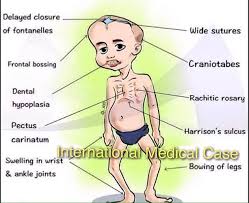 Image result for Craniotabes