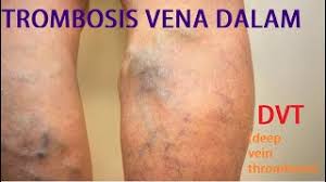 Congenital anomalies of the inferior vena cava and left renal vein: Perbezaan Antara Trombosis Vena Dalam Dan Vena Varikos Penyakit 2021