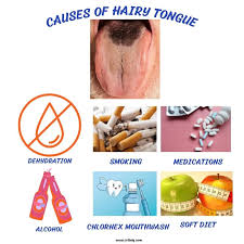Image result for black hairy tongue symptoms
