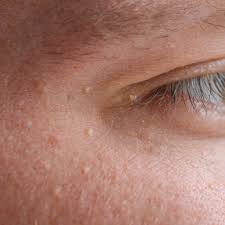 Image result for milium cyst on eyelid