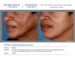 My skin was still flaking even after three weeks of use. Dr Obagi Zo Skin Health Dr Anna Hemming