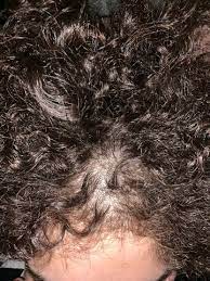 dauer welle haarausfall dauerwelle haarausfall stoppen