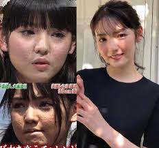 鼻整形の執刀医選び🏥鼻フル、鼻尖形成、目頭切開、鼻中隔延長、鼻翼縮小、輪郭3点、二重切開、小鼻縮小 on X:  肌荒れ、ニキビ、その色素沈着＝シミを鬼滅したスキンケア優勝事例。 👩‍🦳道重さゆみ→透明感爆上げ。美白スキンケア。 👧冬子→ 頬の吹き出物撲滅  👩新井 ...