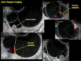 In some rare cases, early stage ovarian cancers may produce symptoms, but in the majority of cases, these if a woman has the signs and symptoms of ovarian cancer, her doctor will probably perform a complete pelvic exam, a transvaginal or pelvic ultrasound, radiological tests, such as a transvaginal. Imaging The Suspected Ovarian Malignancy 14 Cases Mdedge Obgyn