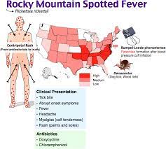 Rosh Review Rocky Mountain Spotted Fever Medical Mnemonics Emergency Medicine