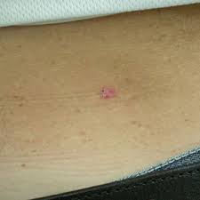 If you aren't sure which type of skin cancer. Do You Know Skin Cancer When You See It Skin Repair