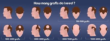 The back of the scalp makes a good extraction area due to the high volume of hair follicles that. Fue Hair Transplant In Michigan Ann Arbor Plastic Surgery