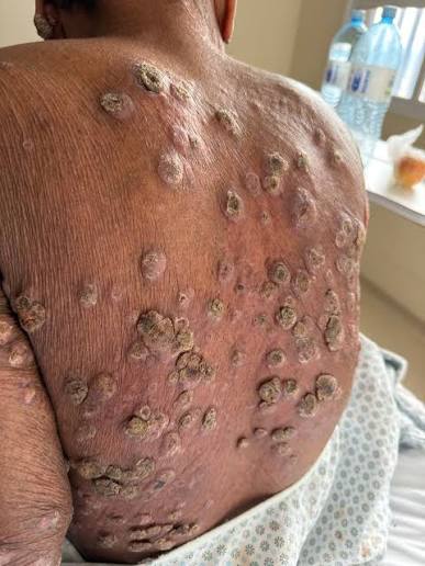 A manifestação verrucosa disseminada é considerada atípica na leishmaniose  tegumentar americana (LTA). A principal espécie responsável é a “Leishmania  (Viannia) braziliensis”. Diferente da leishmanios