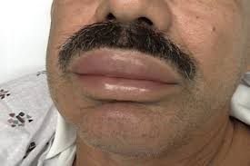 Image result for Angioedema
