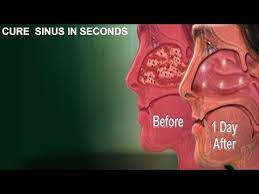 How To Naturally Unblock Your Sinuses In 3 Easy Steps Youtube Sinusitis Congestion Relief Sinus Relief
