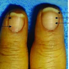 It occurs in patients with thyrotoxicosis. Pdf Alteraciones Ungueales Como Marcador De Enfermedad Sistemica