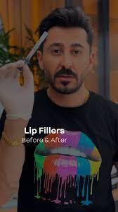 فيلر الشفاه بطريقة طبيعية، ممتلئة و متناسقة مرسومة بيد المايسترو الدكتور  عمر حتّر✨, للإستفسار وحجز المواعيد:, 00962793808889, 📍شارع زهران