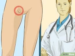 Como Tratar Una Lesion De La Ingle Con Imagenes