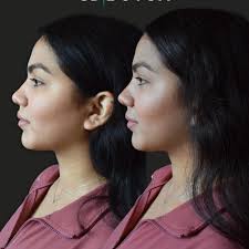 Cool Sculpting Vista, CA