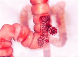 Gu?rison du cancer du colon. On A Trouve Le Talon D Achille Du Cancer Colorectal