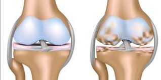 Romatoloji Romatizmal Hastaliklar Osteoartrit Kireclenme Bilgi Ve Paylasim Alani Kadinlar Kulubu