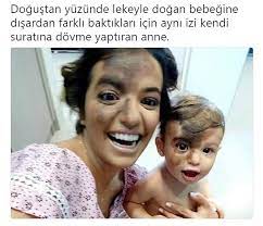 Maybe you would like to learn more about one of these? Dogustan Yuzunde Lekeyle Dogan Bebegine Disardan Farkli Baktiklari Icin Ayni Izi Kendi Suratina Dovme Yaptiran Anne Guldum Net Caps Arama Motoru