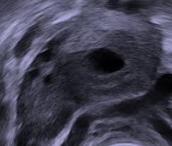 Image result for corpus luteum sonography)