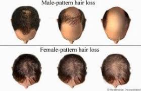 If further support is needed you can contact one of the following support groups 5 Types Of Hair Loss Patterns In Females And Reversible Treatment Bee Choo Ladies