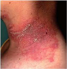 Image result for Linear Dermatitis