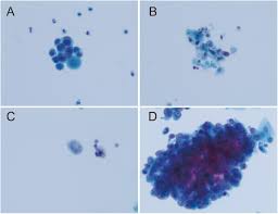 A learning guide 42 7 lasers and alignment 7.1 how lasers work laser is an acronym for light amplification by 23 1 limit the range of wavelengths reaching the detector 2 515 and 545 3 beam splitter 4 shortpass, longpass 49 introduction to flow cytometry: Investigation Of Atyp C Using Uf 5000 Flow Cytometer In Patients With A Suspected Diagnosis Of Urothelial Carcinoma A Single Center Study Diagnostic Pathology Full Text