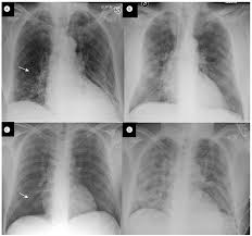 Maybe you would like to learn more about one of these? Scielo Brasil Severity Of Lung Involvement On Chest X Rays In Sars Coronavirus 2 Infected Patients As A Possible Tool To Predict Clinical Progression An Observational Retrospective Analysis Of The Relationship Between Radiological