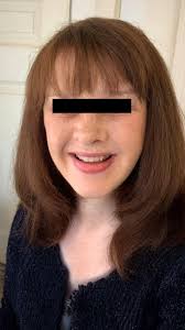 I had cosmetic surgery at a clinic in Turkey called Rememore — 8 in 1  operation! Dr. Can İlker Demir : r/cosmeticsurgery